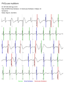HeartInform_PVCs are multiform